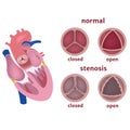 Stenosis of the aortic valve of the heart. Royalty Free Stock Photo